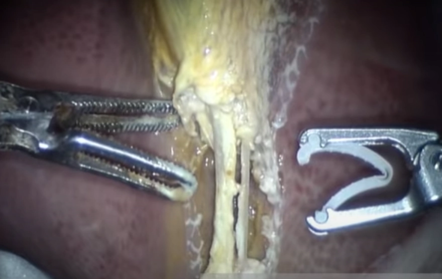 Robot cerrah sıfır hata ile ameliyatı tamamladı ve tüm kararları bağımsız aldı