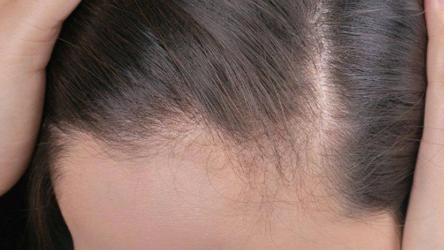 Saç Dökülmesini Anında Durduruyor: Saçlar Daha Hızlı ve Gür Çıkıyor