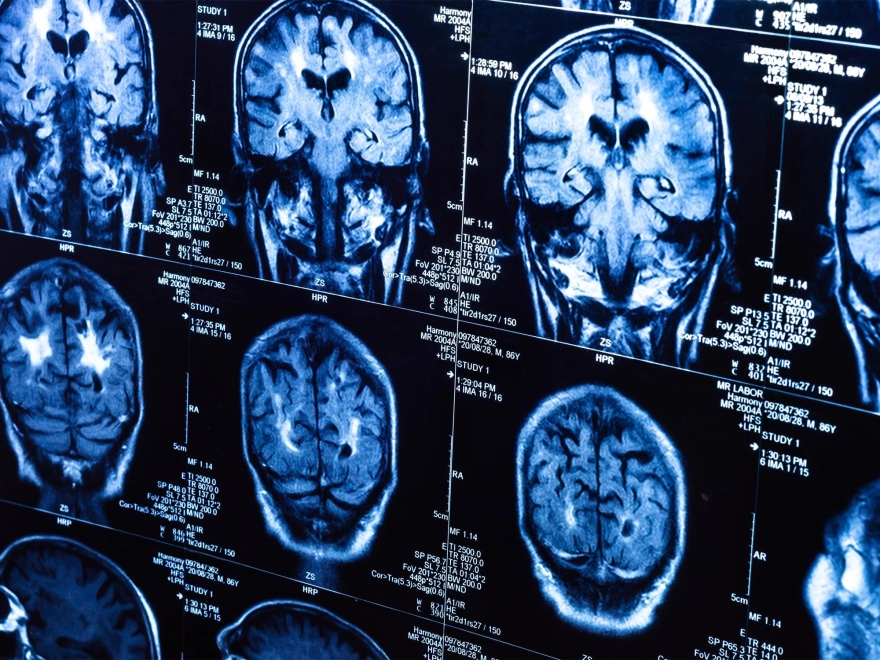 Gizli etki yıllar sonra ortaya çıktı: COVID-19 pandemisi beyni yaşlandırdı