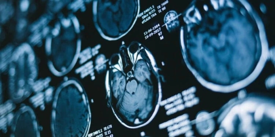 Gizli etki yıllar sonra ortaya çıktı: COVID-19 pandemisi beyni yaşlandırdı