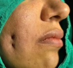 Türkiye'de yaygınlaşan gamze estetiğine uzmanlardan uyarı: Kalıcı hasar riski var